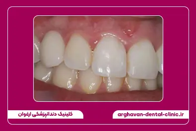 گالری لبخند کلینیک ارغوان کیس پنجم - بعد