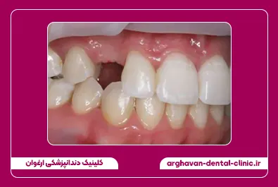 گالری لبخند کلینیک ارغوان کیس پنجم - قبل