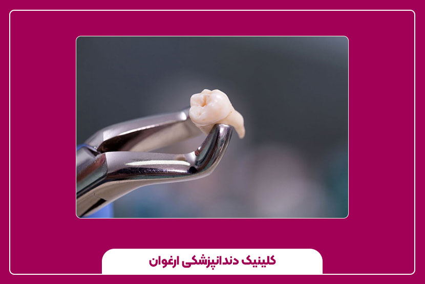 جراحی دندان عقل