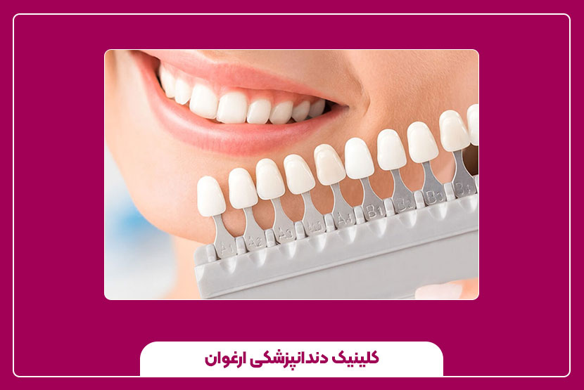 لمینت سرامیکی دندان