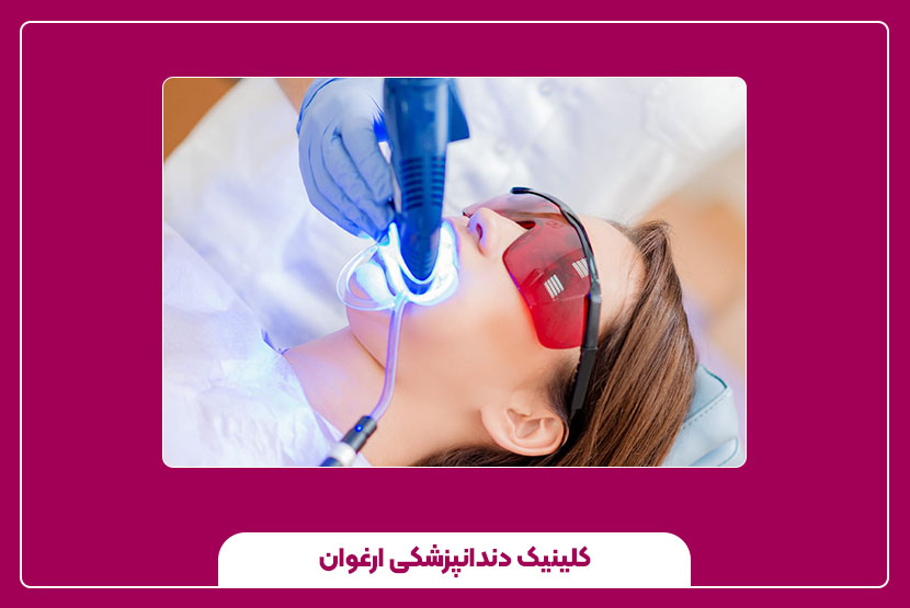 قیمت بلیچینگ دندان در کرمانشاه