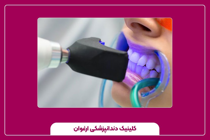 آیا بلیچینگ دندان شامل بیمه میشود؟