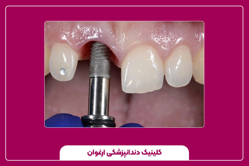 انواع روشهای ایمپلنت دندان