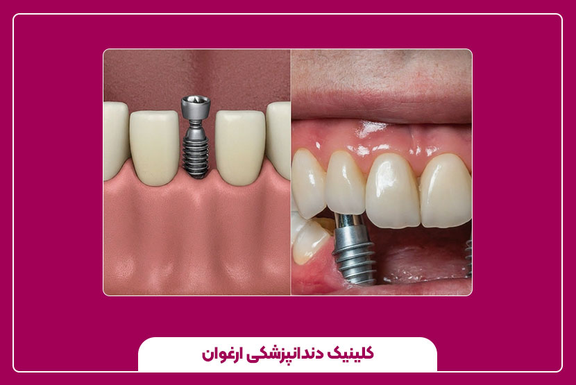 درد دندان بعد از ایمپلنت