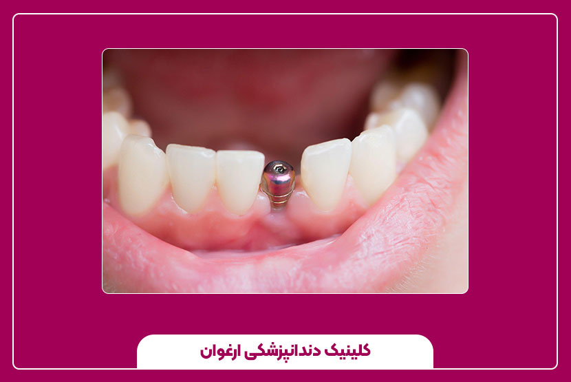 ایمپلنت دندان