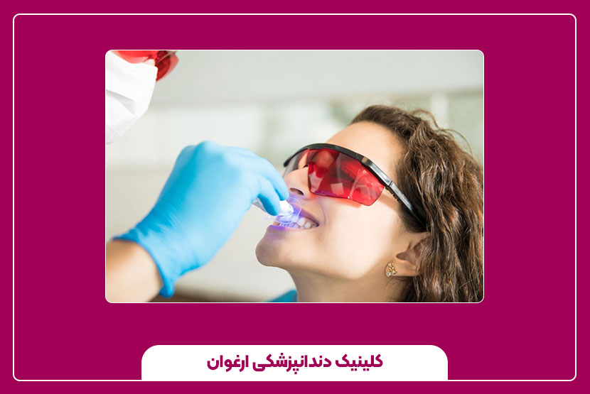 بلیچینگ دندان