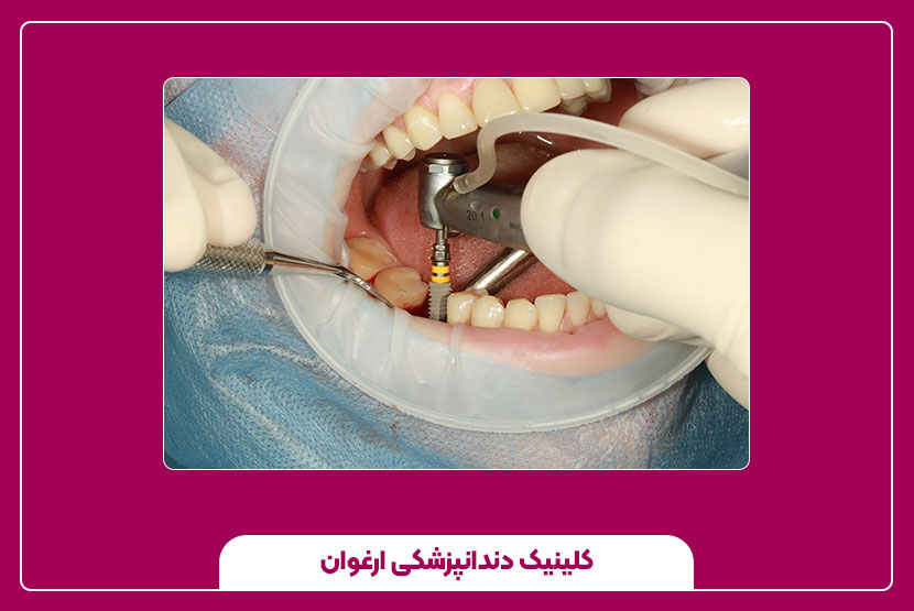 ایمپلنت دندان چقدر طول میکشد؟