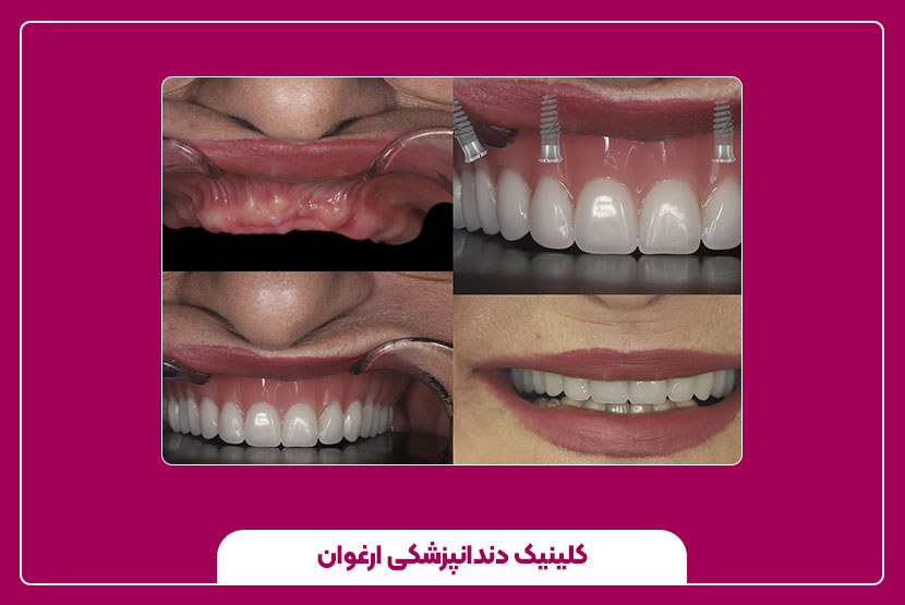 جنس مواد ایمپلنت دندان