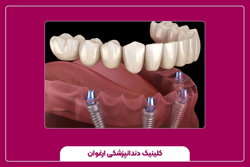 مراقبت قبل و بعد ایمپلنت