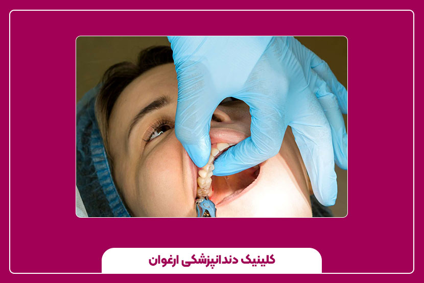 مراقبت بعد از کشیدن دندان عقل