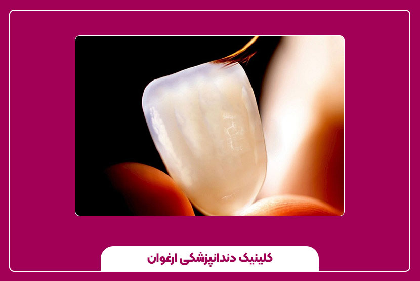 قیمت لمینت سرامیکی هر دندان