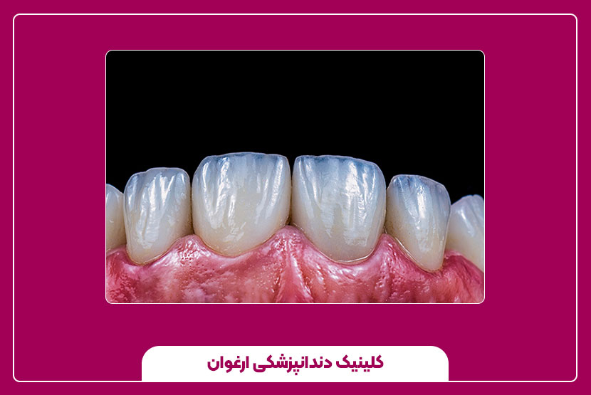 لمینت دندان سرامیکی vita ویتا