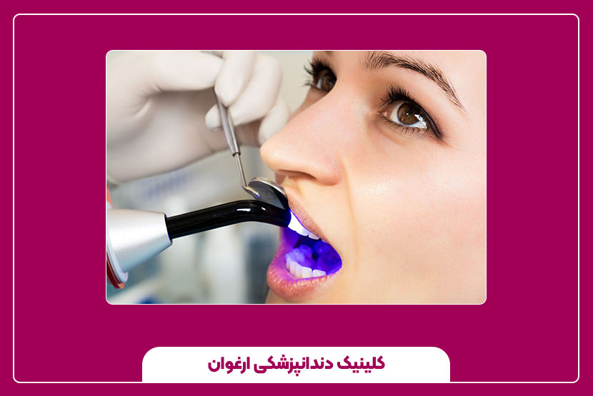 ترمیم کامپوزیت دندان