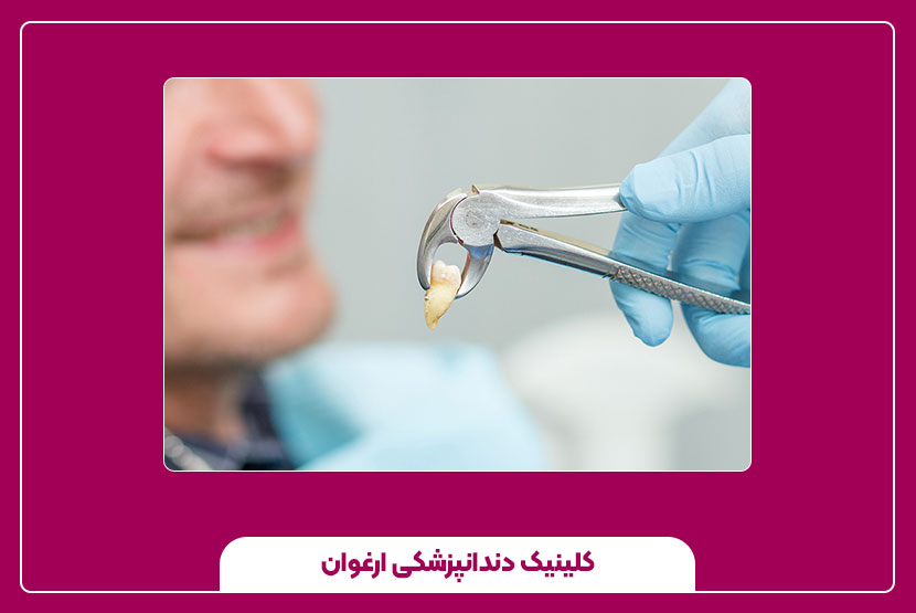 راهنمای کامل، مراحل و مراقبت‌های عصب کشی دندان عقل 