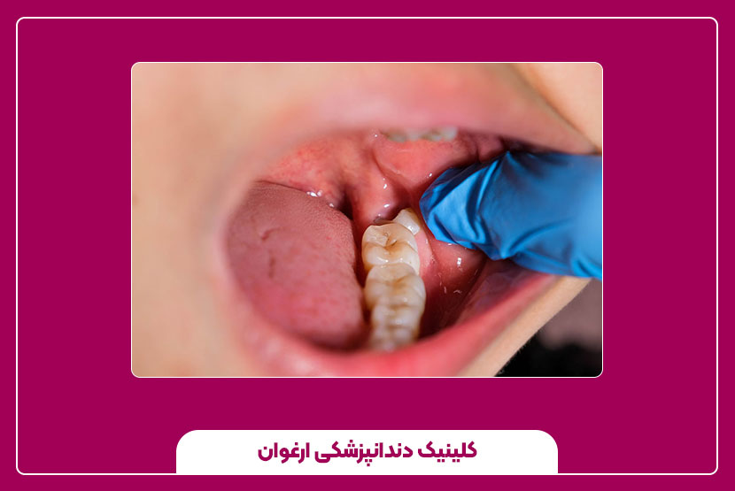 ترمیم دندان عقل