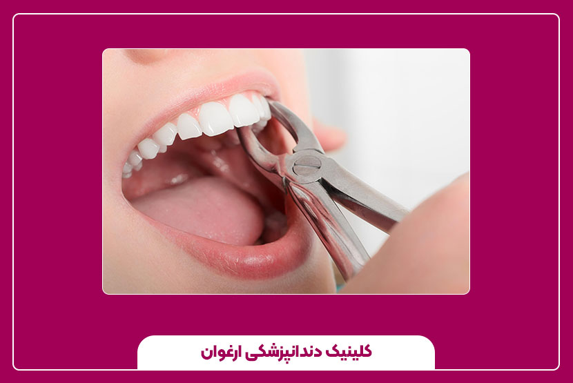 کشیدن دندان