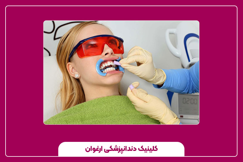 تفاوت جرم گیری و بلیچینگ دندان
