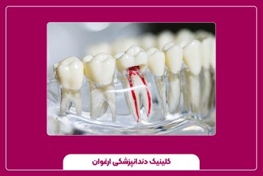 کانال دندان چیست؟