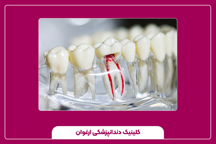 کانال دندان چیست؟