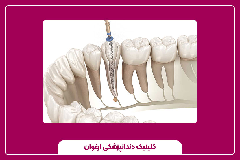 هزینه و عوامل مؤثر بر قیمت درمان کانال دندان