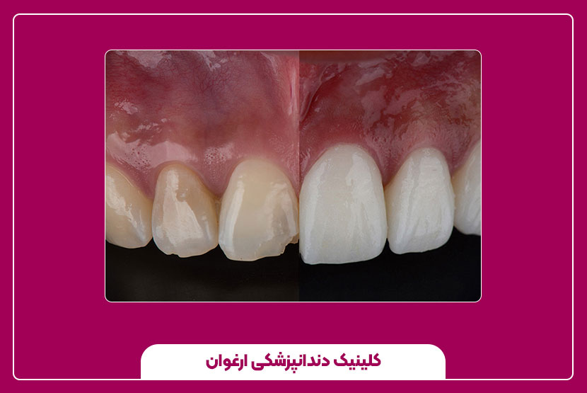 ونیر کامپوزیت دندان