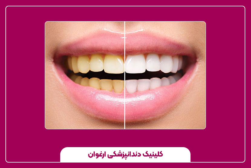 جرم گیری دندان