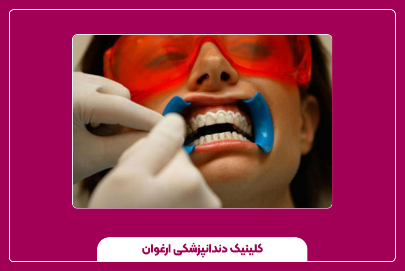 مزایا و معایب جرم‌گیری دندان