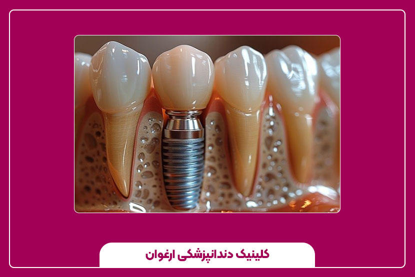 مراحل ایمپلنت دندان