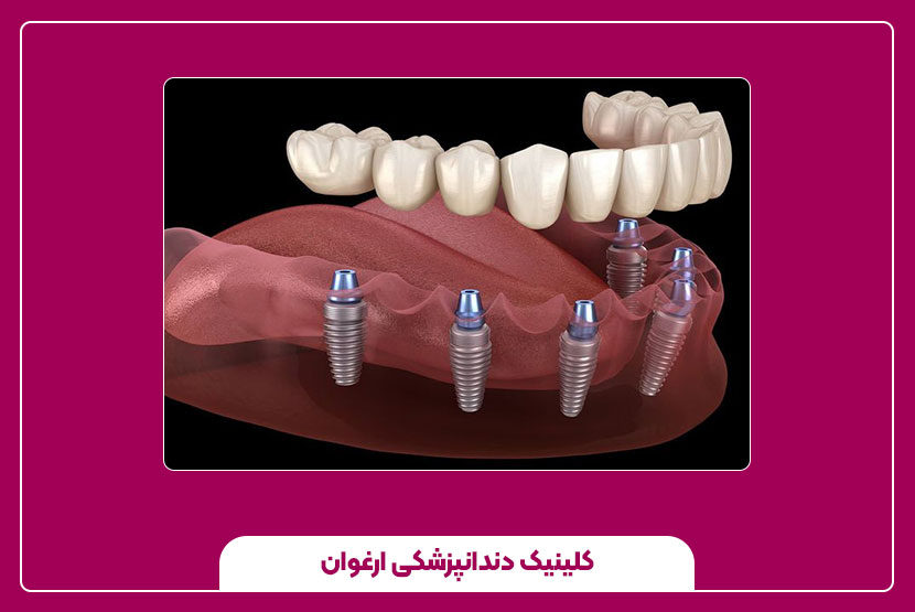 روش ایمپلنت دندان