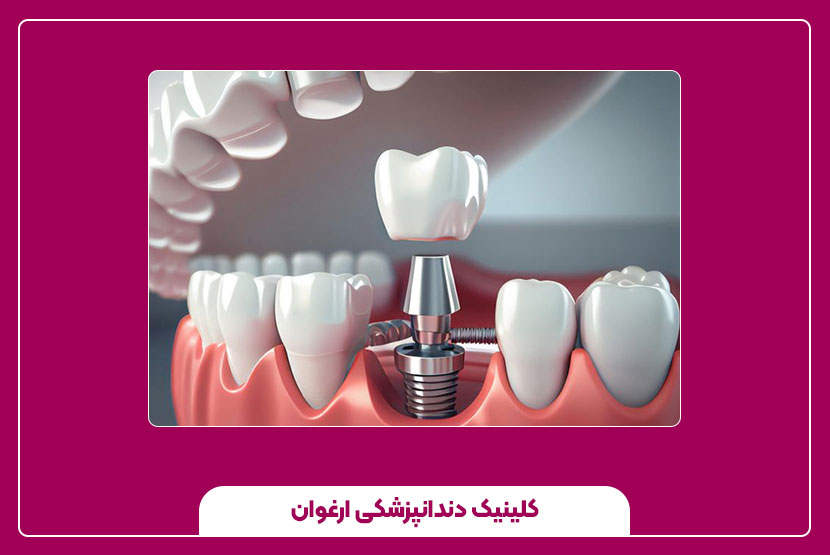 جرم‌گیری ایمپلنت دندان