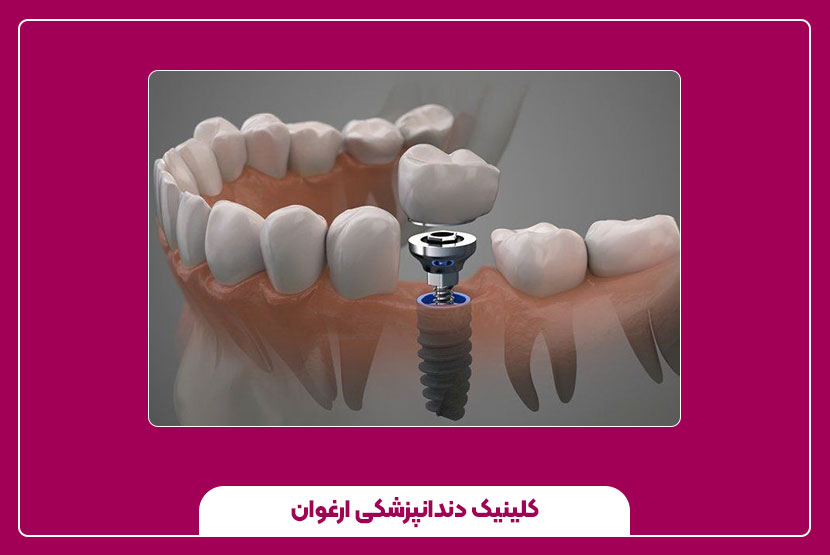 مراقبت‌های بعد از ایمپلنت دندان