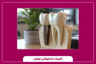 ایمپلنت دندان تا چه سنی انجام می‌شود؟