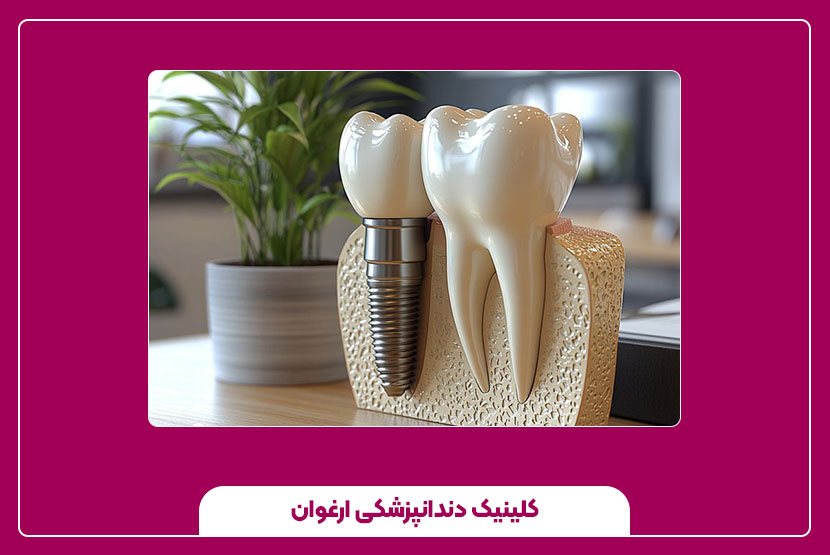 ایمپلنت دندان تا چه سنی انجام می‌شود؟