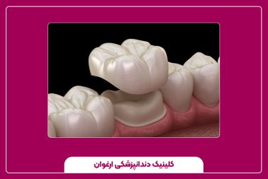 همه چیز درباره روکش دندان