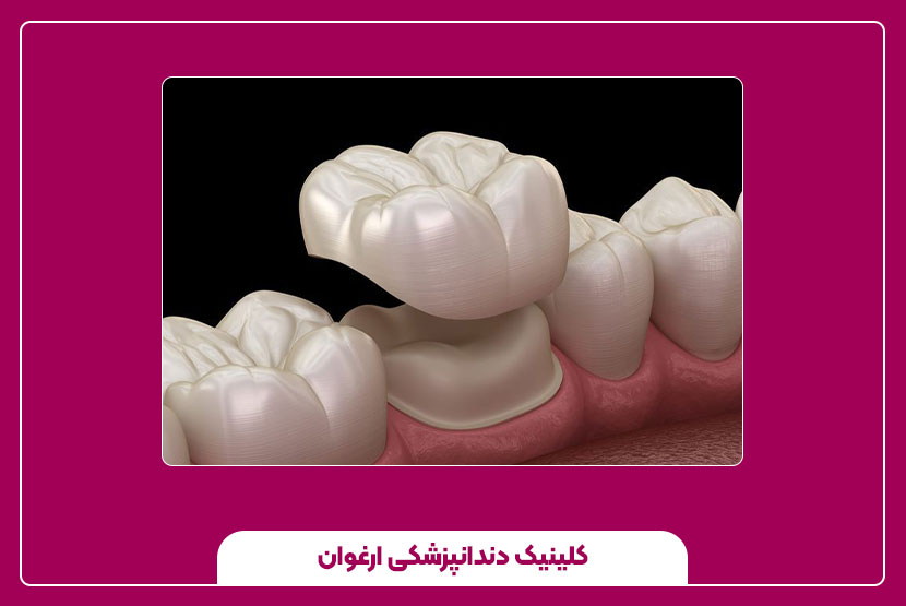 همه چیز درباره روکش دندان