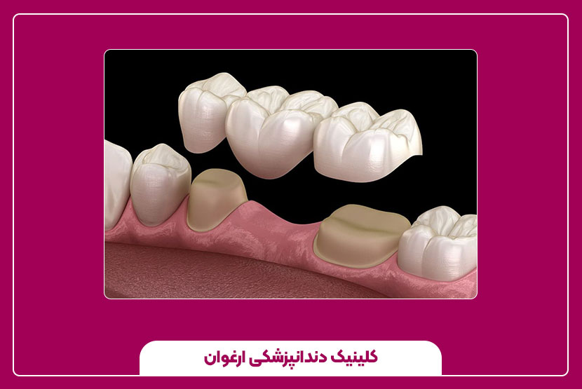 مزایا و معایب روکش دندان