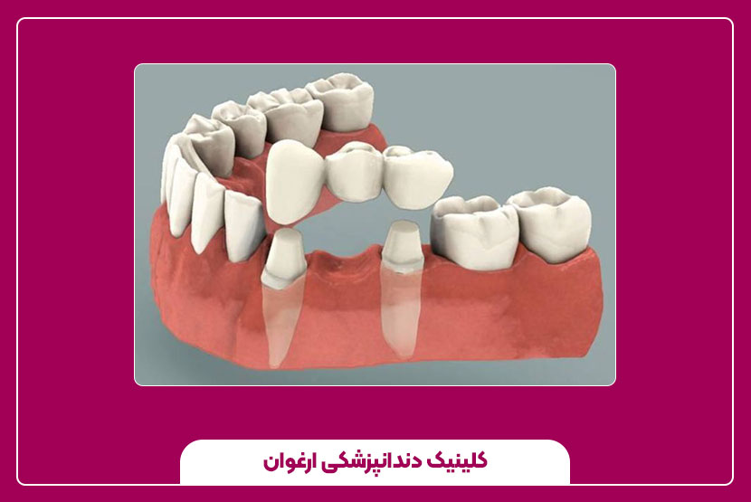 مراحل نصب روکش دندان