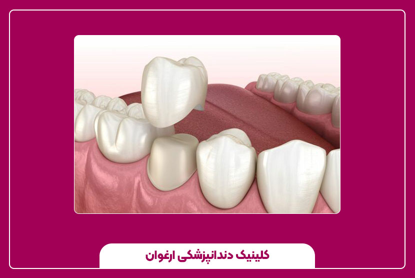 هزینه روکش دندان