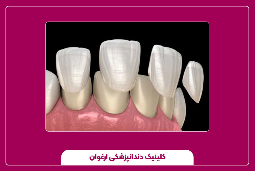 مراقبت‌های بعد از نصب روکش دندان