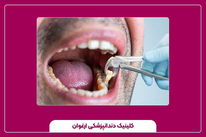 اقدامات فوری بعد از کشیدن دندان