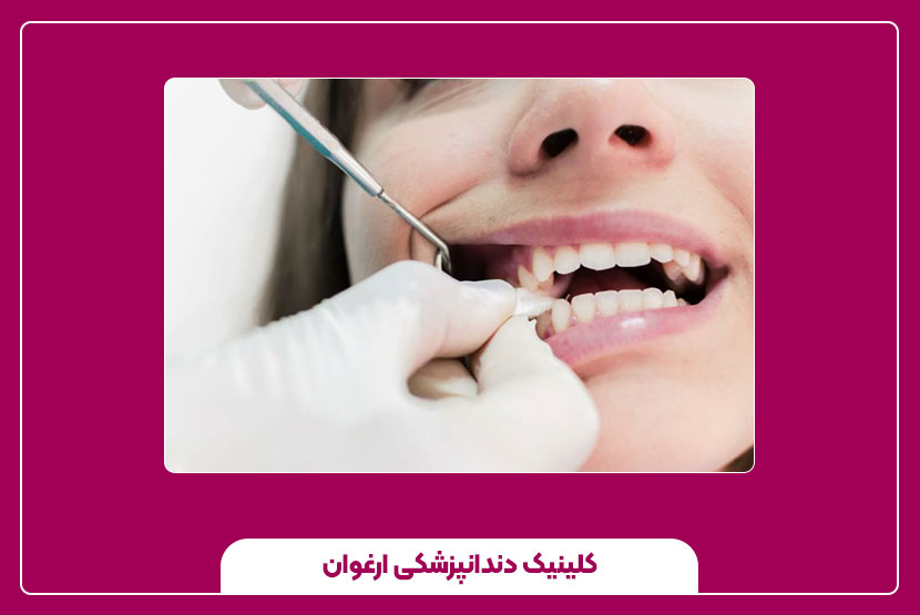 مراقبت‌های بعد از کشیدن دندان