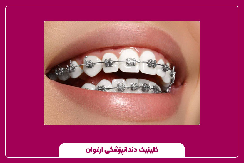 همه چیز درباره ارتودنسی