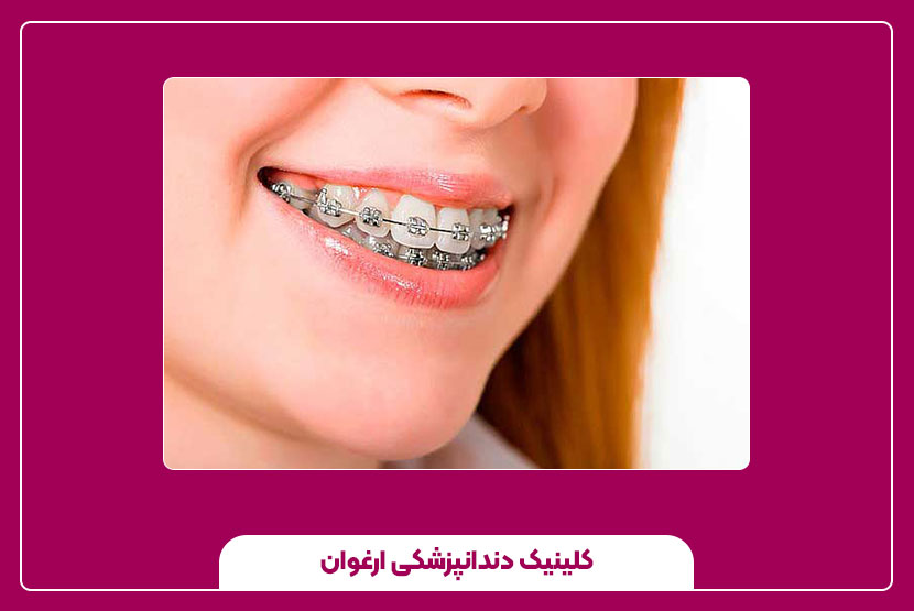 انواع روش‌های ارتودنسی