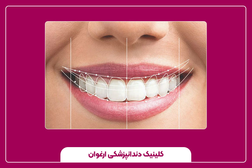 اصلاح طرح لبخند دندان