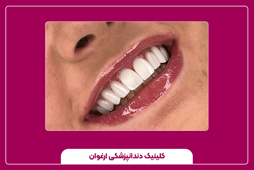 اصلاح طرح لبخند دندان