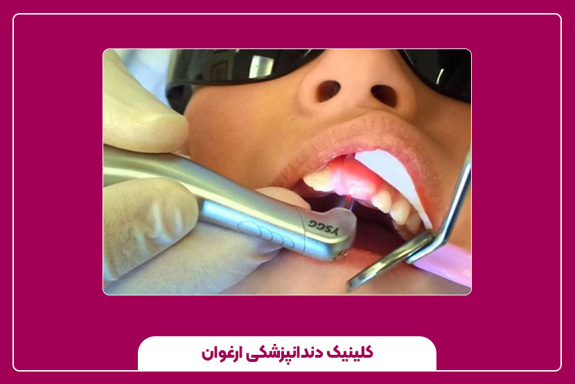 مراقبت‌های بعد از ترمیم دندان با لیزر