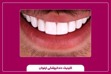 مزایا و معایب ترمیم کامپوزیت