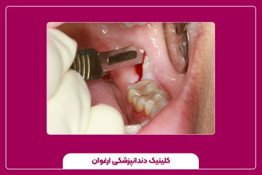 انواع روش‌های ترمیم دندان عقل