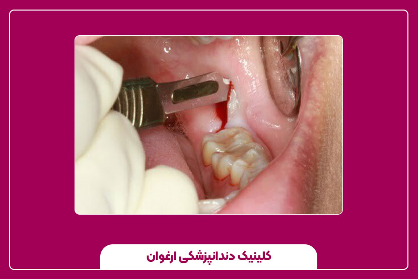 انواع روش‌های ترمیم دندان عقل