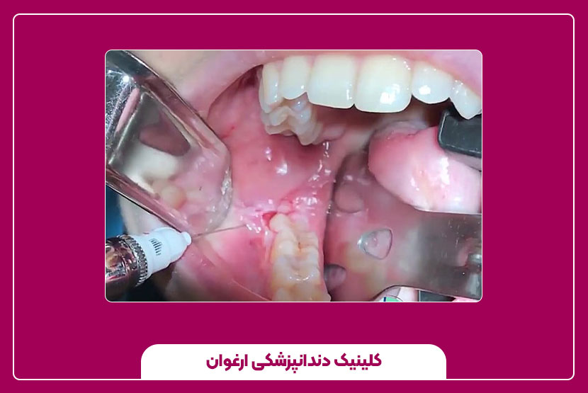 پر کردن دندان عقل